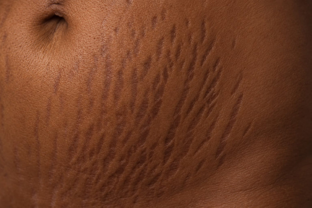Stretch Marks?Here’s How We Treat Them