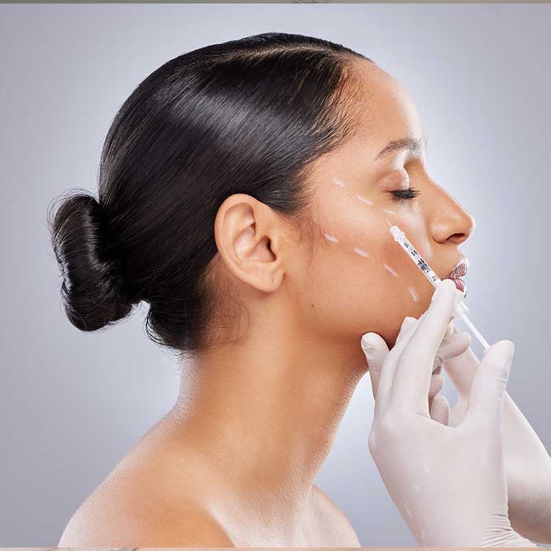 Dermal filler treatment