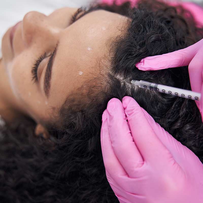 Exosomes scalp mesotherapy