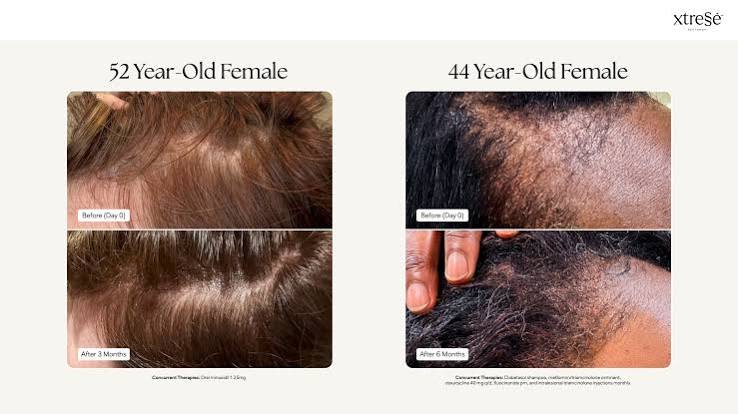 Xtressé Hair Growth Gummies — IMAGE SKIN + CO.