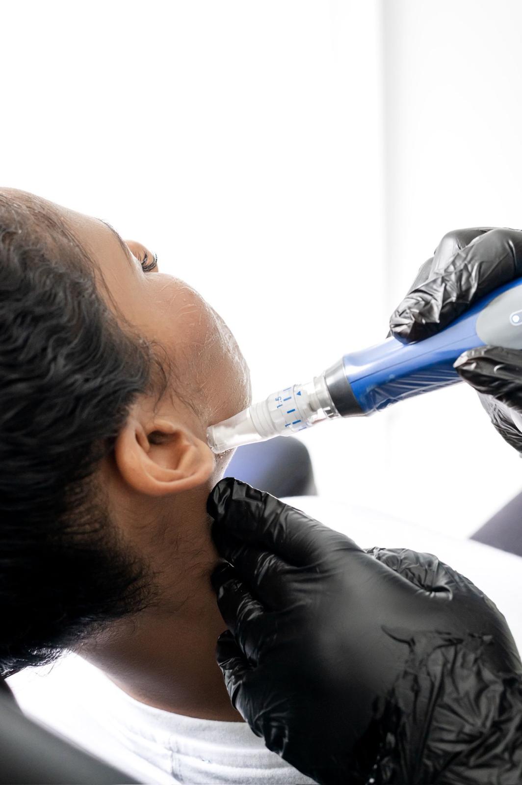 Microneedling treatment